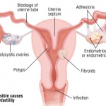 Infertility in women