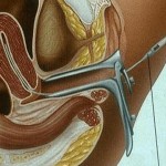 Artificial Insemination