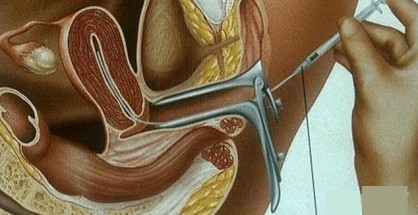 Artificial Insemination